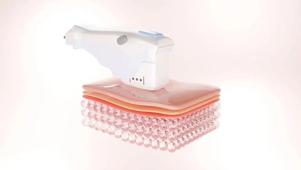 HIFU BIJ AVORIA Osdorp