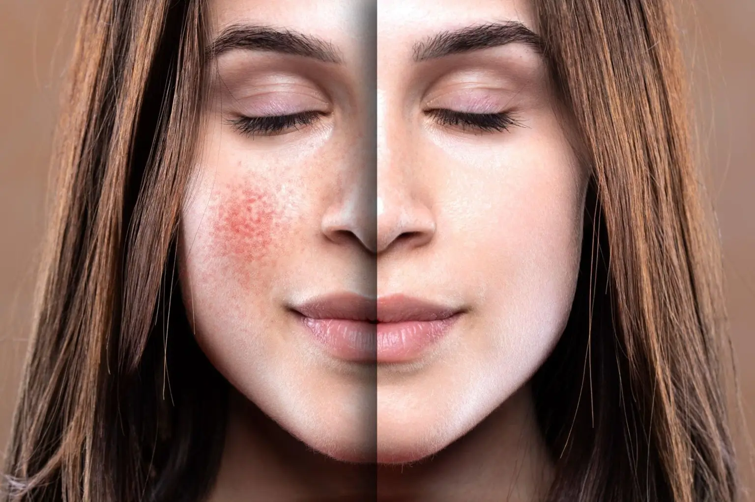 rosacea Avoria Amsterdam Osdorp