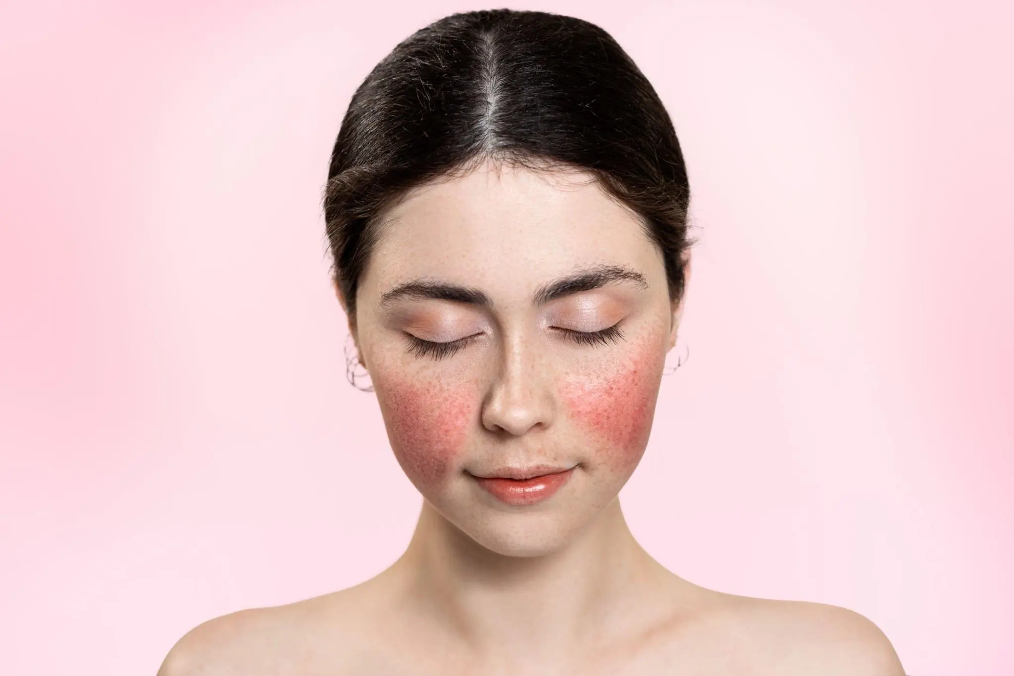 rosacea behandeling bij Avoria Amsterdam Osdorp