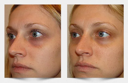 ME Line Dark Circle behandeling in Amsterdam osdorp