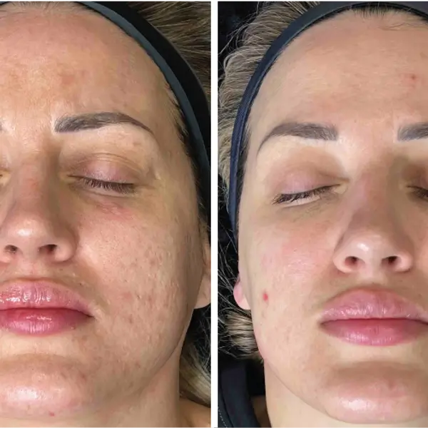 Microneedling in Amsterdam1